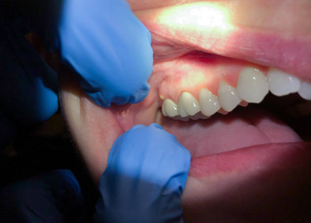Best Emergency Tooth Extraction in Bourbon, MO